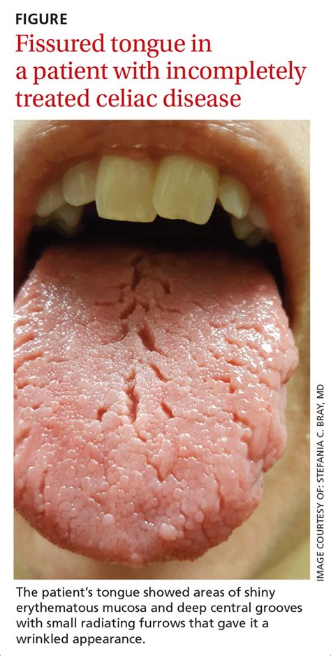 Fissured tongue forum Doctor Ricky tells us what this tongue full of cracks and valleys is called in medical terms: it's a fissured tongue